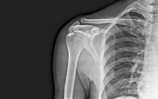 Shoulder Digital X-ray